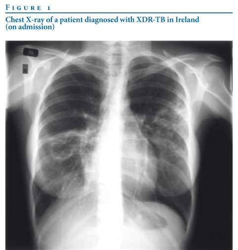 tuberculosis x ray. Chest X-ray of a patient