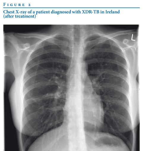 The final chest X-ray showed
